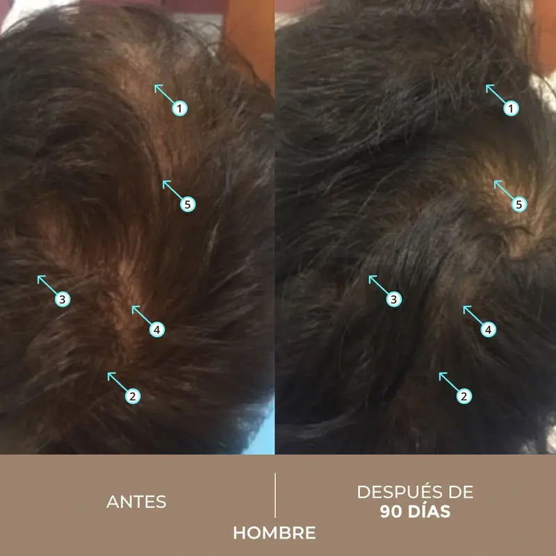Ds Laboratories Spectral Λοσιόν Dnc-N Θεραπεία 3 Μηνών με Nanoxidil® 5% κατά της τριχόπτωσης, 180 ml
