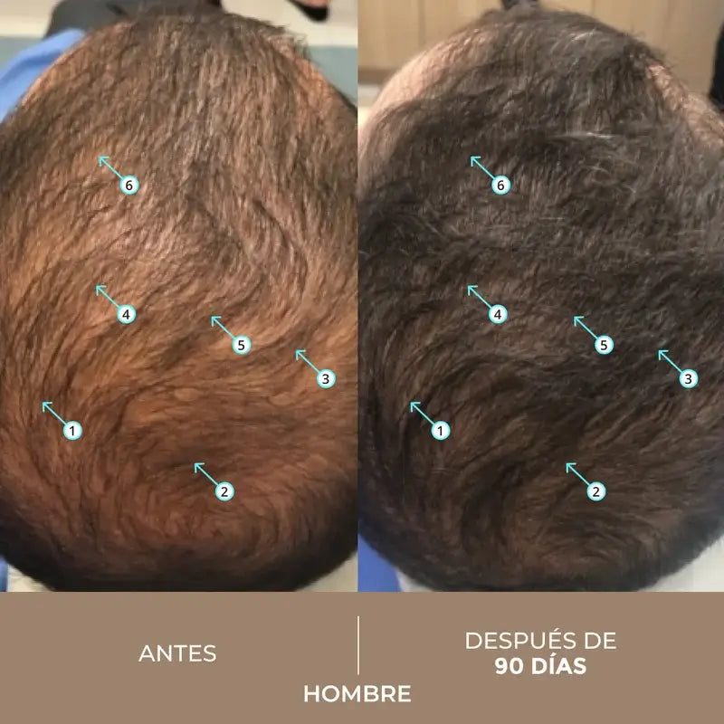 Ds Laboratories Spectral Λοσιόν Dnc-N Θεραπεία 3 Μηνών με Nanoxidil® 5% κατά της τριχόπτωσης, 180 ml