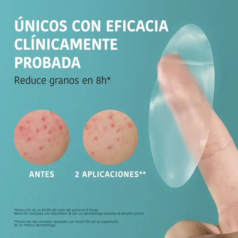 Iroha Nature Xl Pimple Patch, 5 τεμάχια